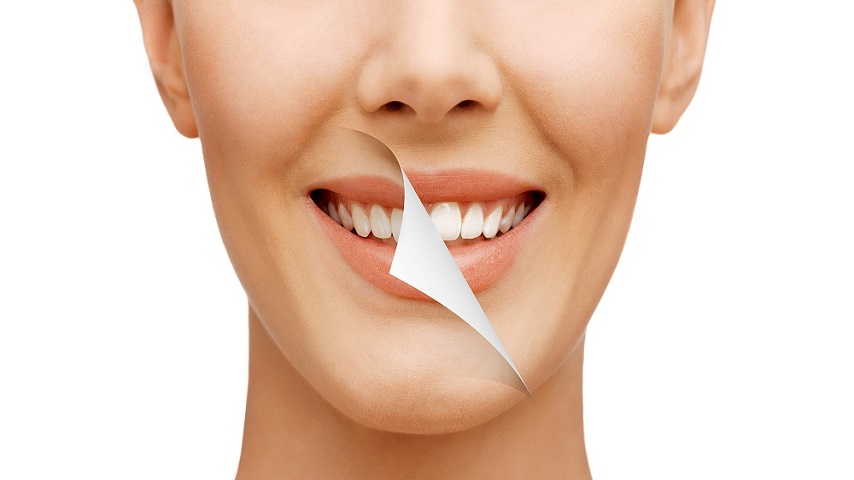 A Step-By-Step Guide To Teeth Whitening In Toronto